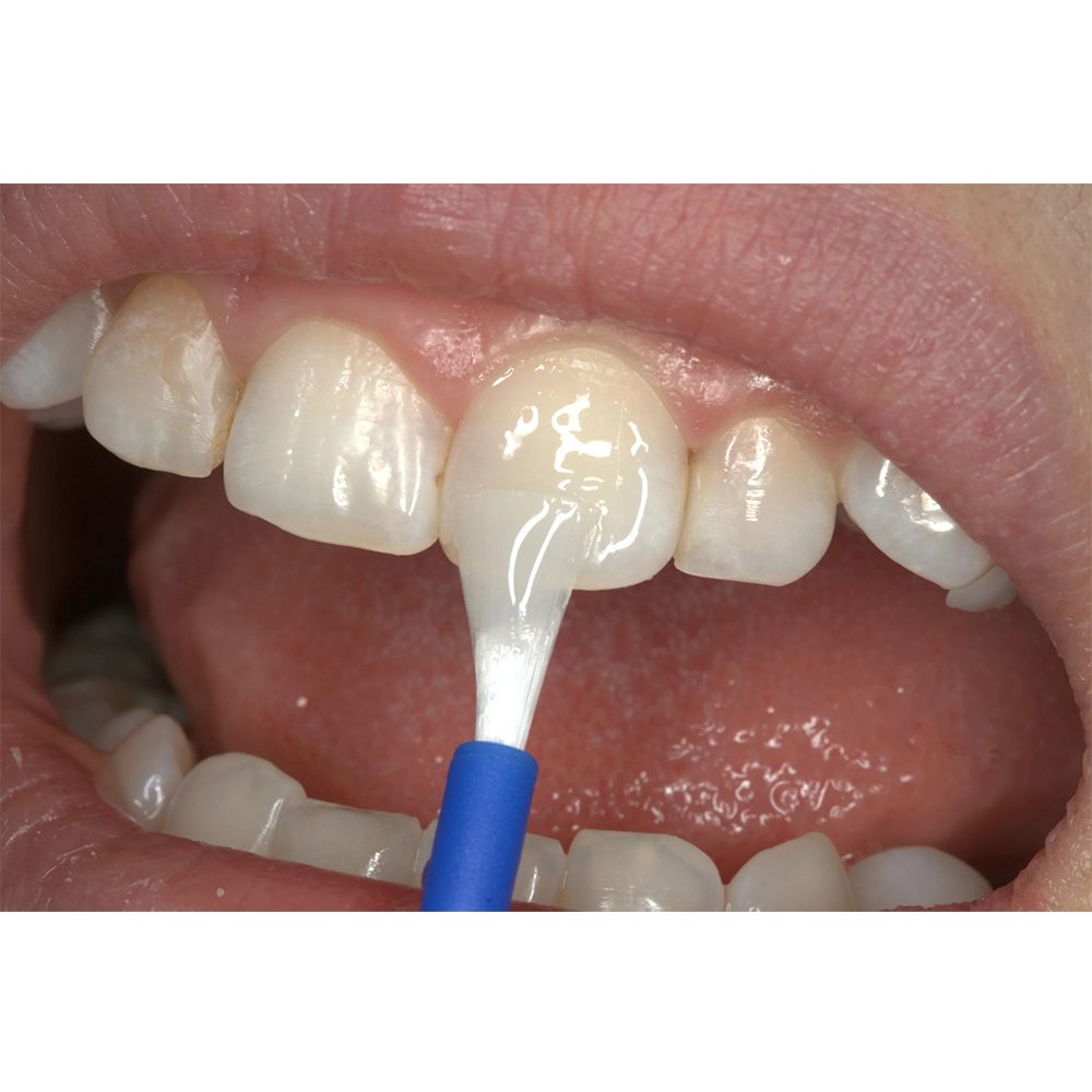 Voco Profluorid Varnish