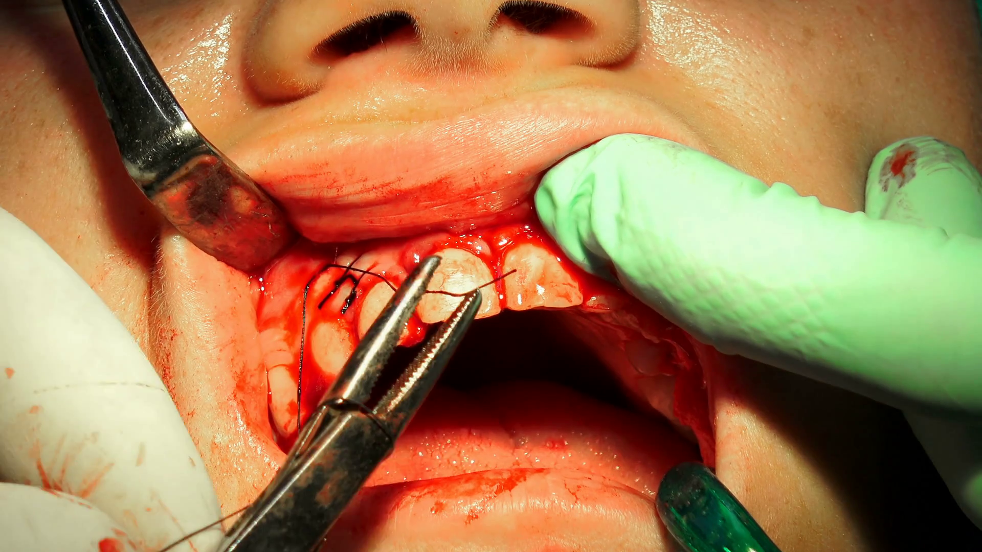 Waldent Needle Holder Mayo-Hegar 160mm #Straight (5/101)