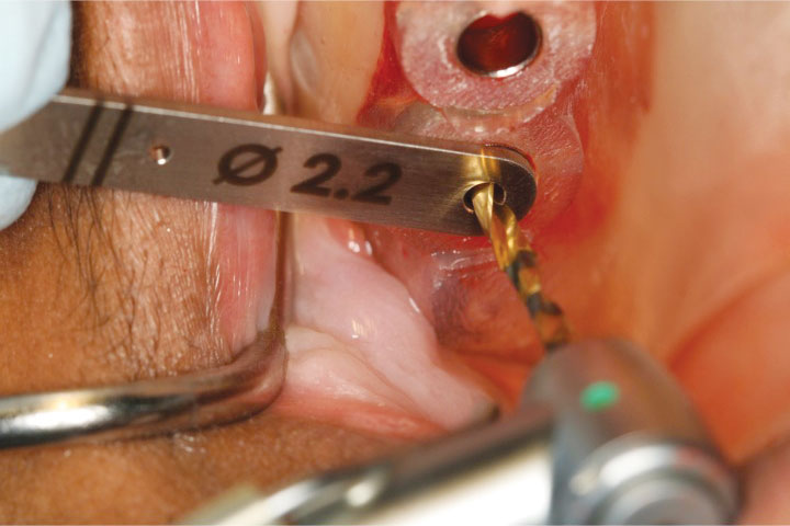 Waldent Lindemann Drill Bit 1.8mm Titanium Coated 19/108