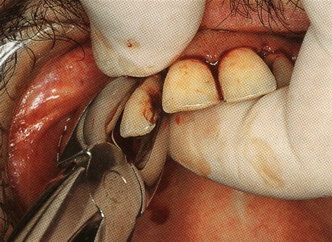 Waldent Tooth Extraction Forceps Upper Anteriors, No.1 (1/101) 