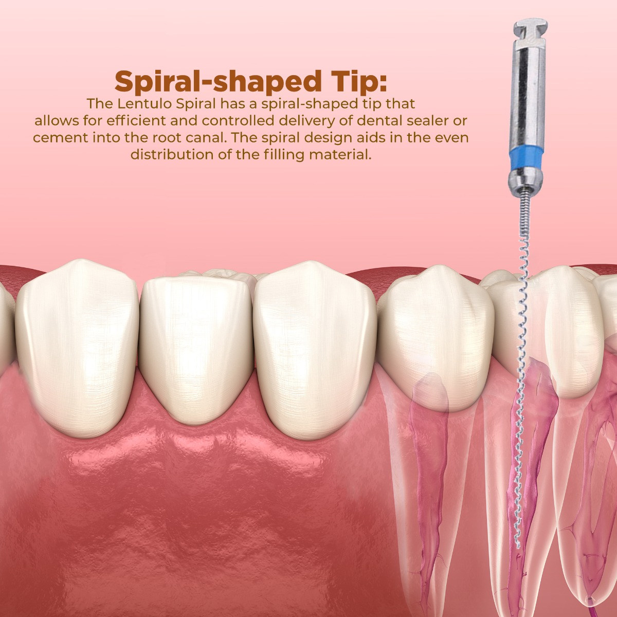 Waldent Paste Carrier (Lentulo Spiral) 21mm #25-40 (Pack of 4)