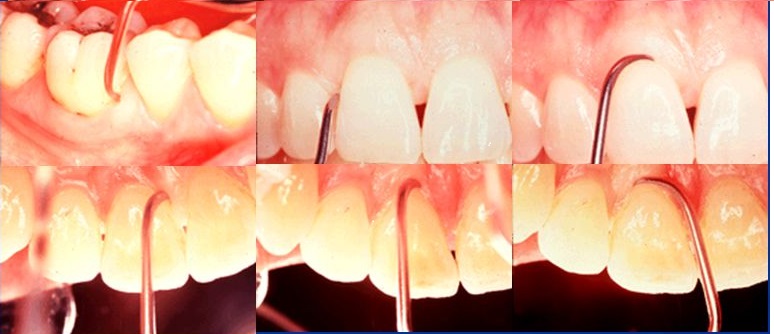 Waldent Gracey Curettes