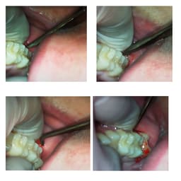 GDC Root Elevators Warwick James Set Of 3 (Ewjs3) - 4