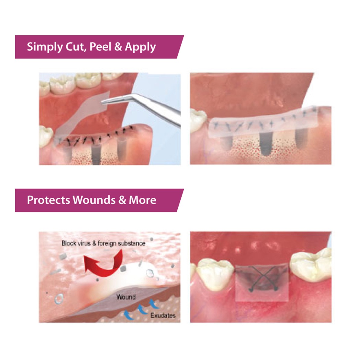 Ora-Aid Attachable Intra-oral Wound Dressing 