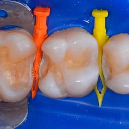 Bioclear Diamond Wedges Refills/Kit - 7