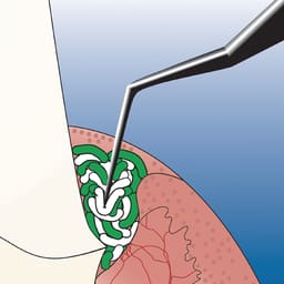 Ultradent Ultrapak Cord - 12