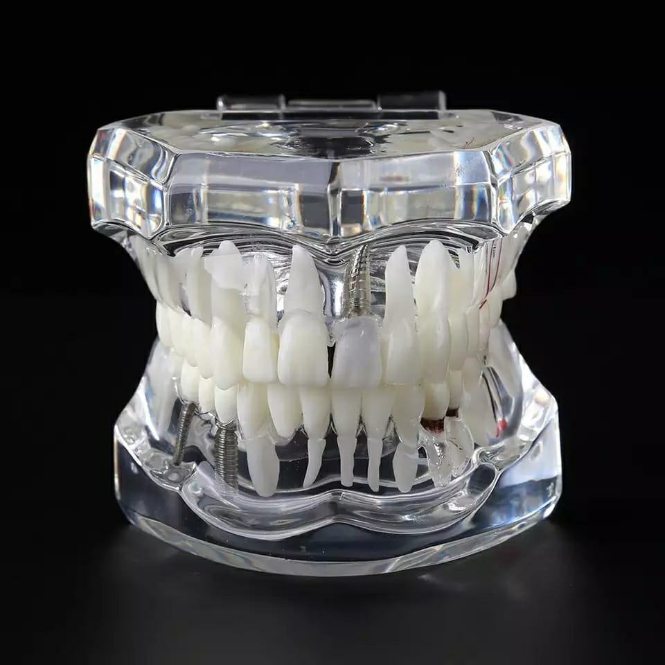 iDENTical All In One Dental Implant Model - M2001 (White)