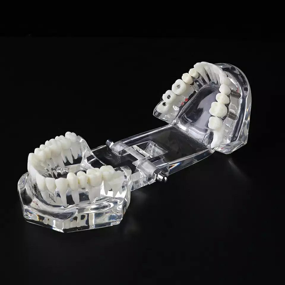 iDENTical All In One Dental Implant Model - M2001 (White)