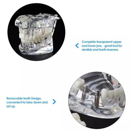 iDENTical All In One Dental Implant Model - M2001 (White)