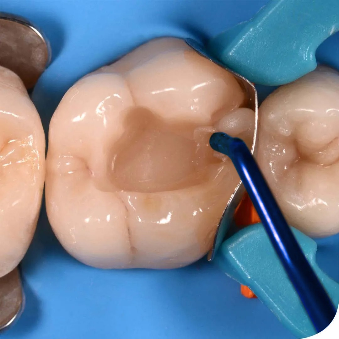 GII Composite Instruments Teflon Coated - Blue (set of 6)