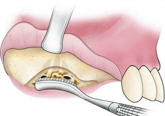 Waldent Oral Surgical Impaction Kit Set of 21 (K9/2) 