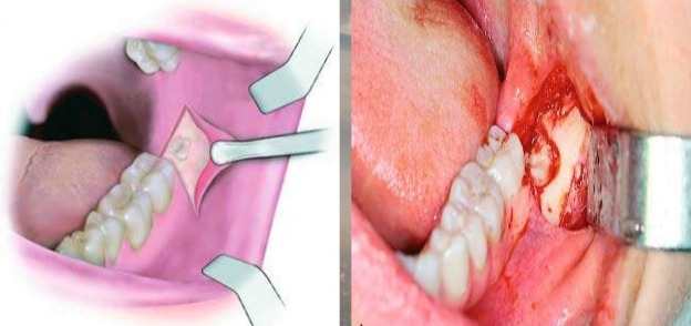 Waldent Oral Surgical Impaction Kit Set of 21 (K9/2) 