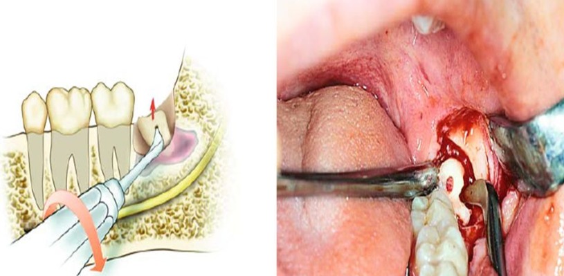 Waldent Oral Surgical Impaction Kit Set of 21 (K9/2) 