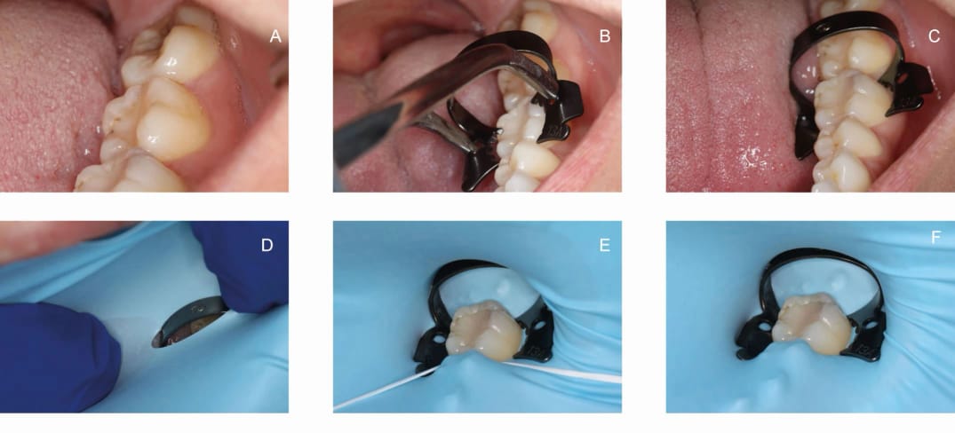Waldent Rubber Dam Clamps Kit Titanium Black (Set of 11) (K16/4)	