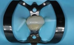 Waldent Rubber Dam Clamps Kit Titanium Black (Set of 11) (K16/4)	 - 12