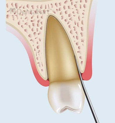 Waldent Periotome Set of 4 (K40/2)