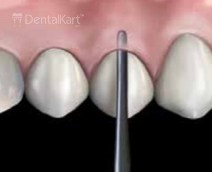 Waldent Periotome Set of 4 (K40/2)