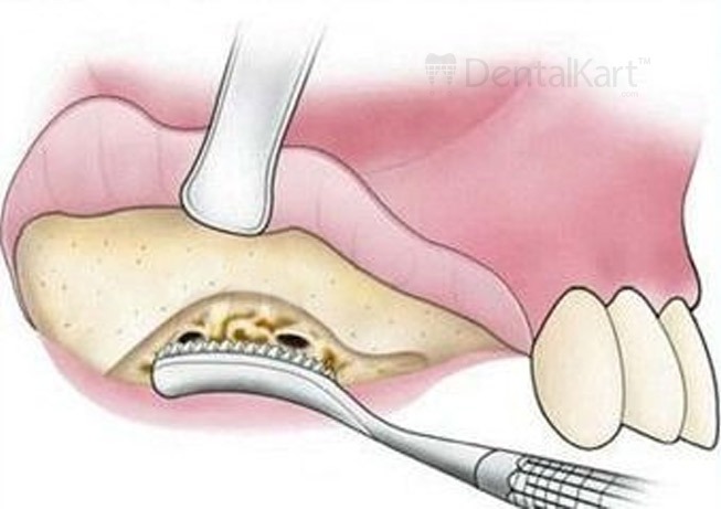 Waldent Oral Surgical Instruments Kit of 10 (K9/1)