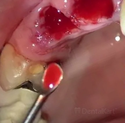 Waldent Wal-Curettes Lucas Bone Curette