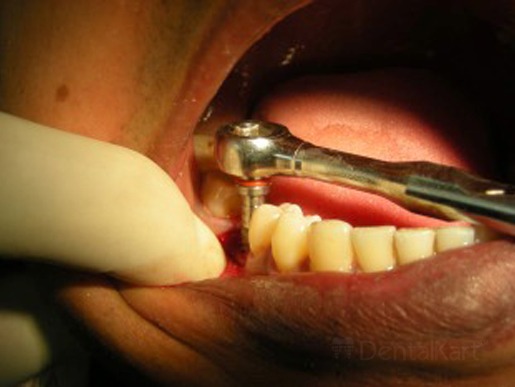 Waldent Implant Ratchet Wrench Dual Sided (19/110)