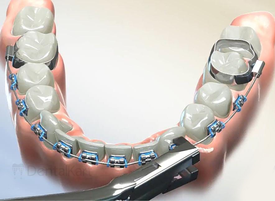 Waldent Orthodontic Bracket Remover Angular Pliers 10/126