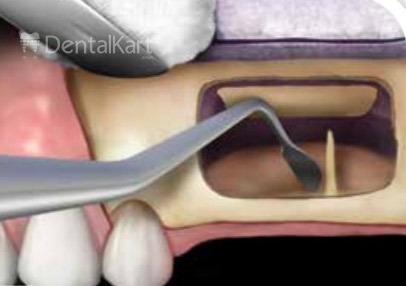 Waldent Bone Graft Kit (k19/7)