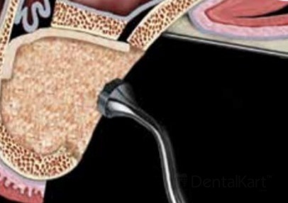 Waldent Bone Graft Kit (k19/7)
