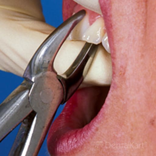 Waldent Tooth Extraction Forceps Upper Anteriors, No.1 (1/101)