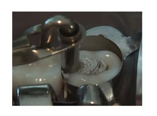 Waldent Amalgam Carrier Double Ended 2.5 x 2.0mm (12/105)