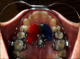 U Ortho Facebow Standard - 7