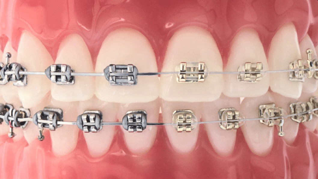 U Ortho NiTi Archwire - Rectangular (pack of 10)