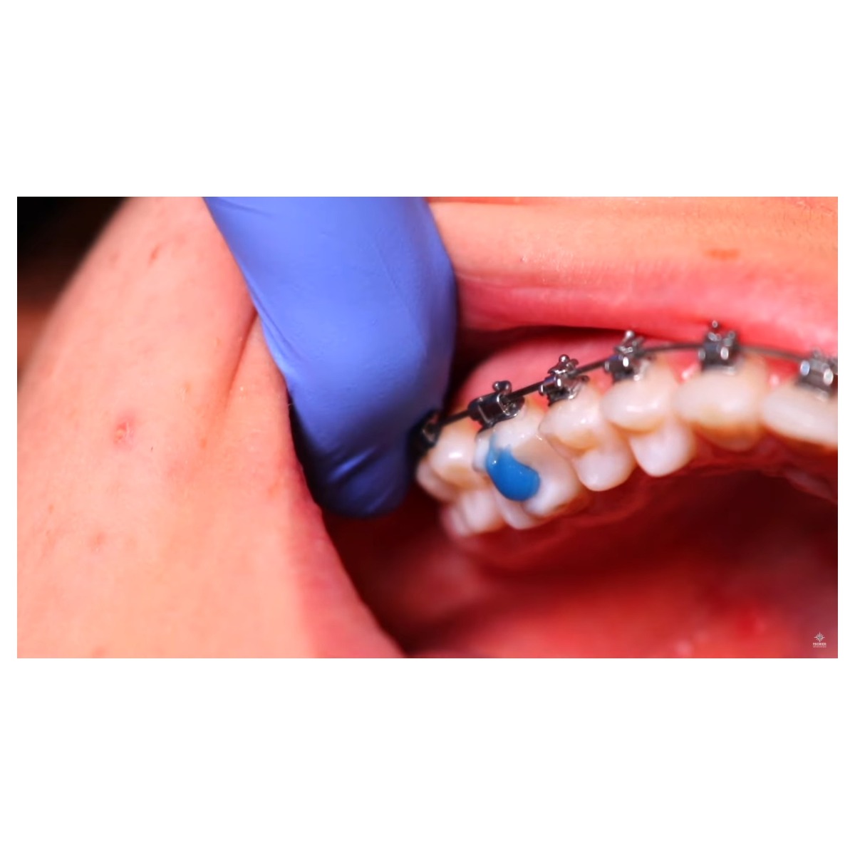 Waldent Blue Bite-Block