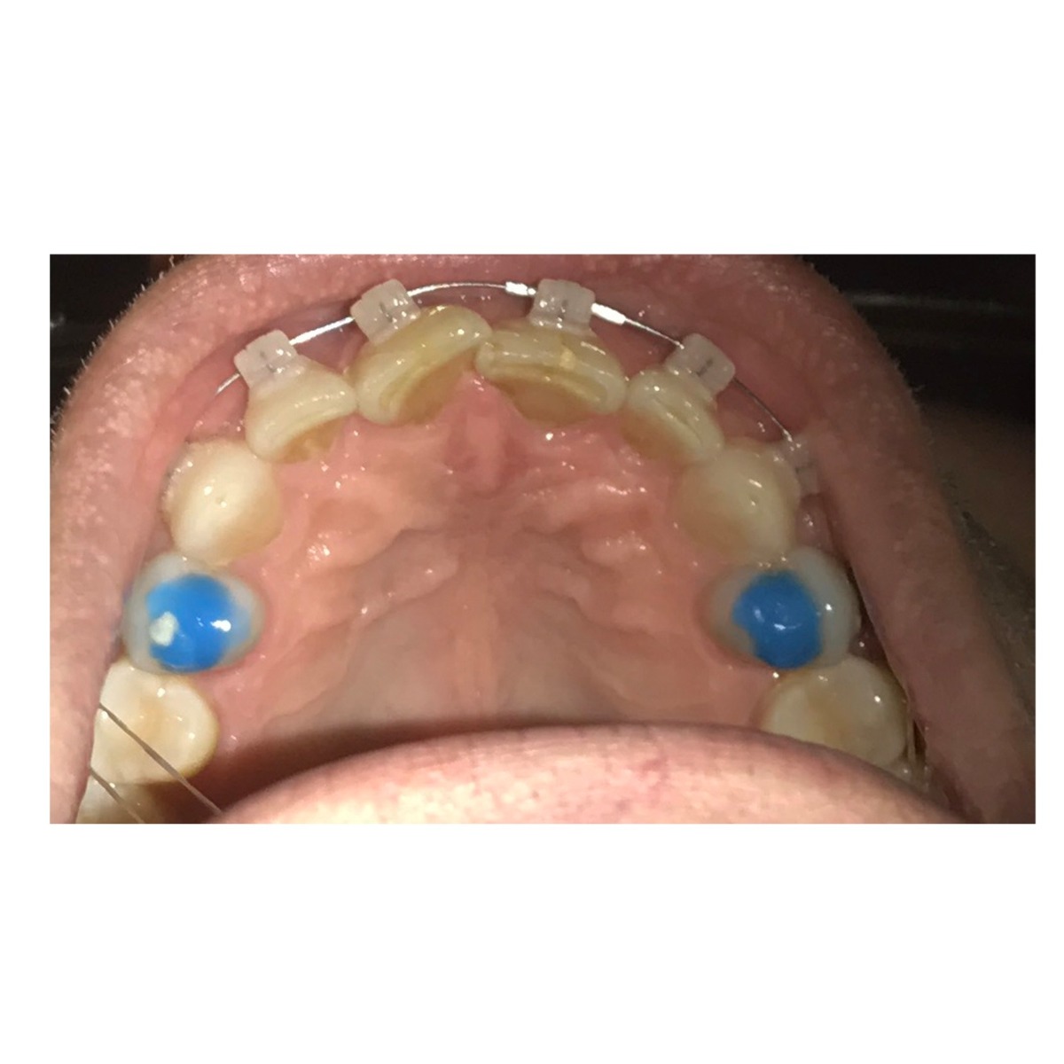 Waldent Blue Bite-Block