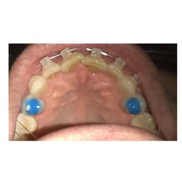 Waldent Blue Bite-Block - 15