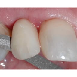 Tor Vm Metal Diamond Strips - 6