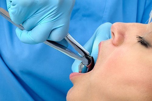 Oracraft Lower Anteriors And Roots Extraction Forceps - Premium (FX74P)