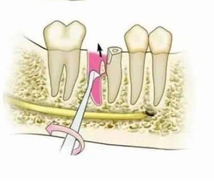 GDC Root Elevators Seldin Standard (E4l)