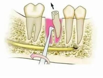 GDC Root Elevators Seldin Standard (E4l)
