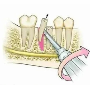 GDC Root Elevators Seldin Standard (E34)