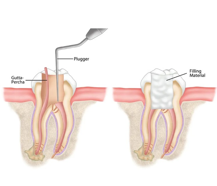 GDC Root Canal Plugger Luks -(.50mm) Rcpl2 #3