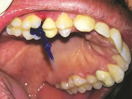 Rolex Inlay Casting Wax