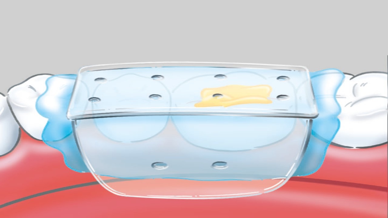 Kulzer Memosil 2 - (2 x 50 ml)