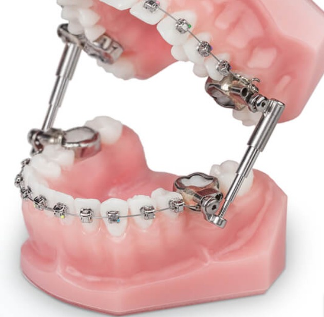 Ormco Advansync 2 Class II Corrector