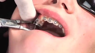 Ormco Advansync 2 Class II Corrector