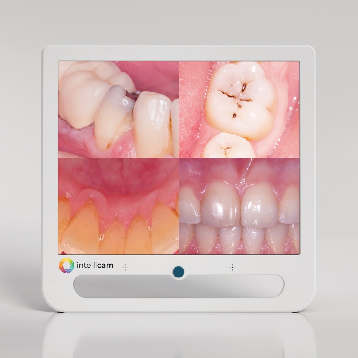 Intellicam 16MP Intraoral Camera with 17" Screen