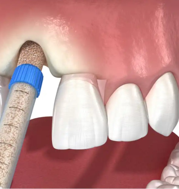 Xcem Osspore Bovine Bone / TCP Mix Grafts For Sinus And Implantitis Repair