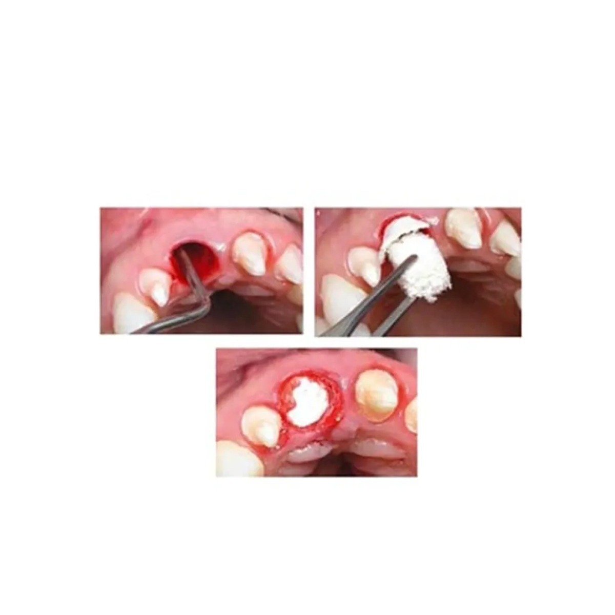 Xcem Osspore Gelatin Foams