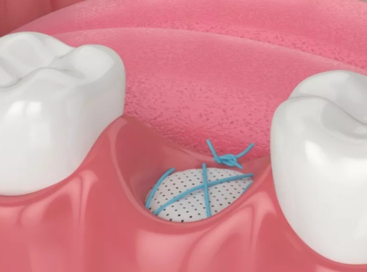 Xcem Osspore PTFE Membranes 