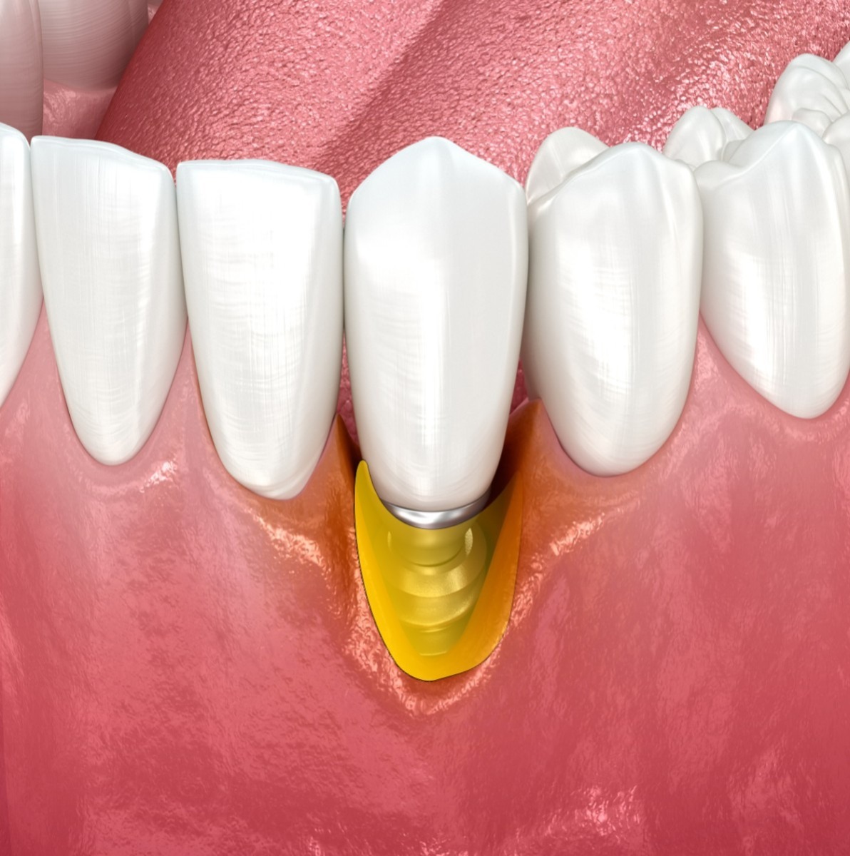 Xcem Osspore Perio Chip    