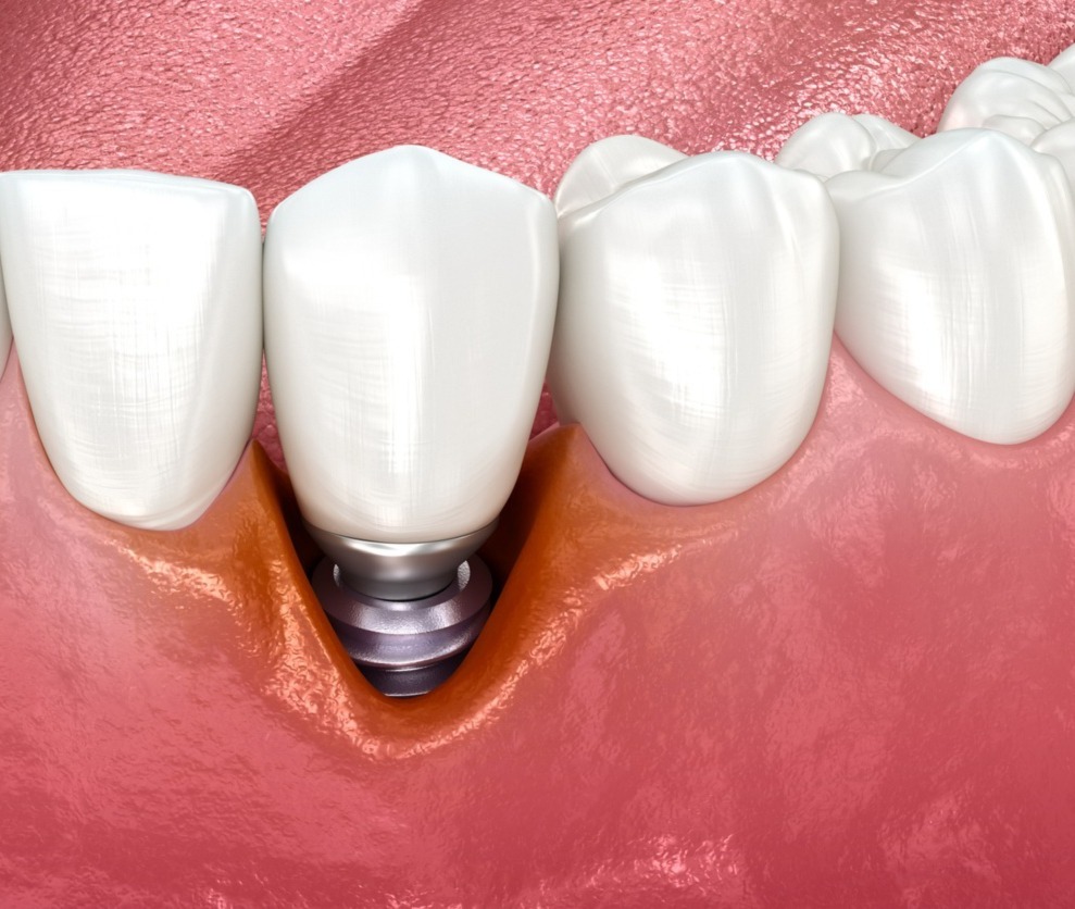 Xcem Osspore Perio Chip    